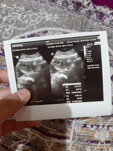 Mau tnya dong bun klo usia 6week baru kliatan kantungnya aja itu normal?