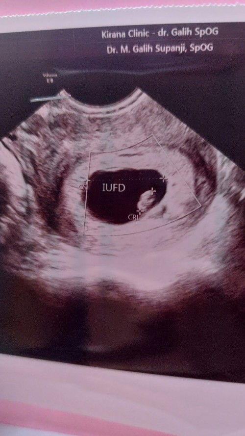 Kehamilan dinyatakan IUFD 12 minggu😭
