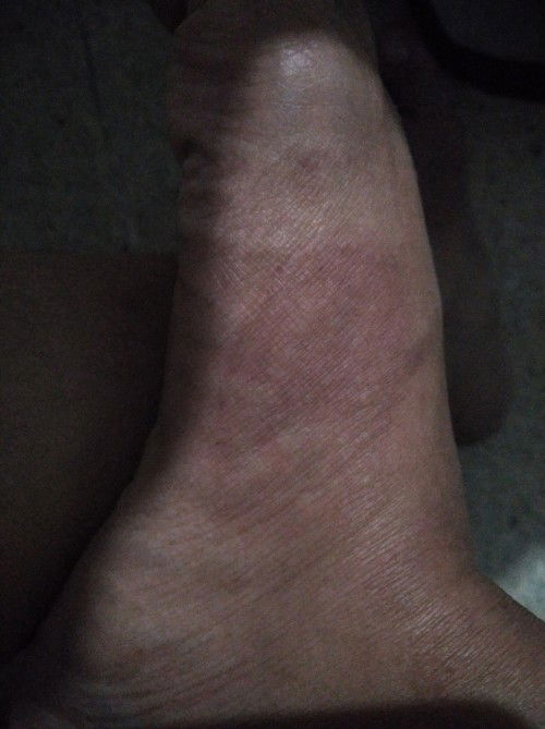 Bunda, adakah yang kakinya merah gatel2 saat hamil? enaknya dioles apa yaa bund? Takut minum obat ni