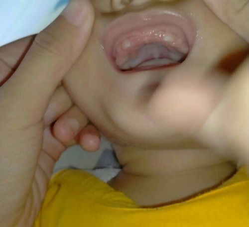 Pernah di insisi krna tongue tie dan lip tie