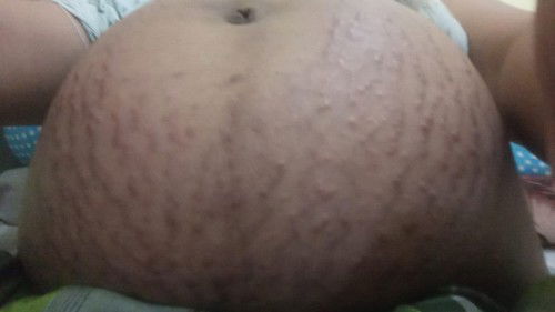 Gatal seluruh badan di usia 33wks