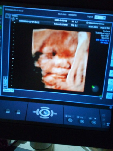 ตอนนี้35วีคแล้วทีมสิงหาคมแชร์ประสบการณ์กันหน่อยค่ะเป็นยังไงกันบ้างอาการ