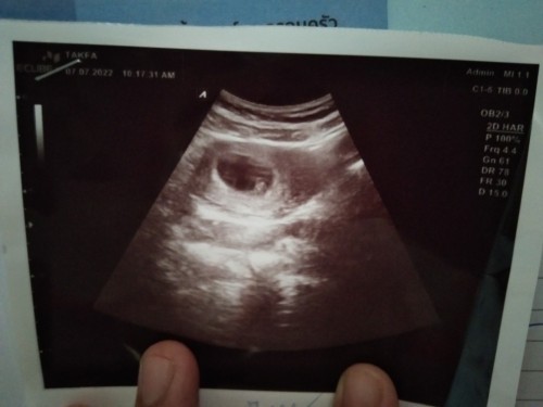 กำลังตั้งครรภ์