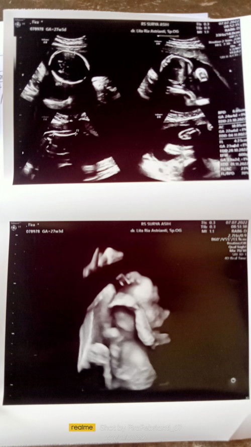 Antara Dokter Dan Bidan, Dan Cara Apa Agar BBJ Bisa Normal...