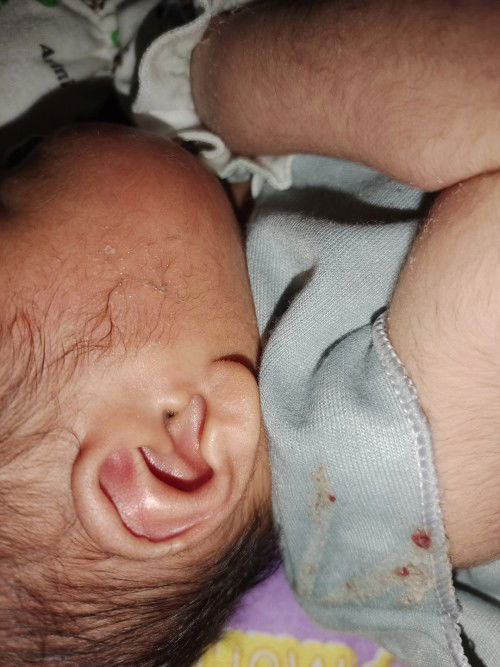 Gumoh bayi bercampur bercak darah usia bayi 5 hari