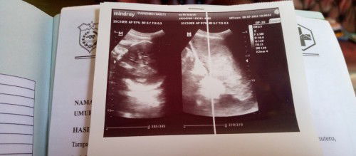 Kalo udah di saranin USG sama bidan jadi nya risi