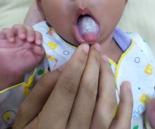 Lidah putih karena jarang dibersihkan