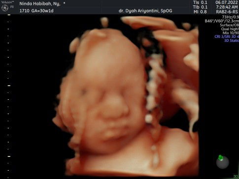 Baby girl hpl September