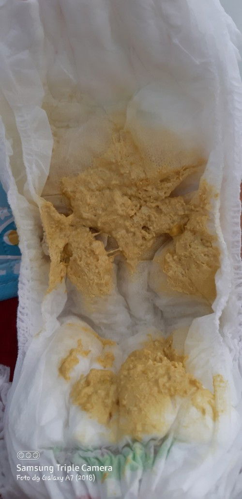 Warna dan tekstur pup bayi sufor