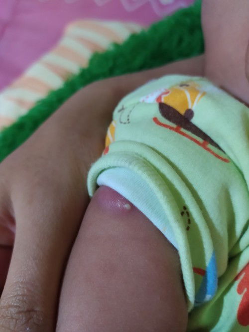 Bisul setelah imunisasi BCG