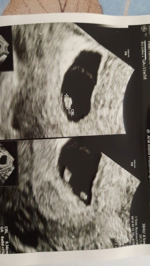 Usia kehamilan 9 week janin ada denyut jantung gak ada, mohon sarannya bunda