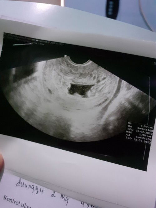 Janin tidak berkembang