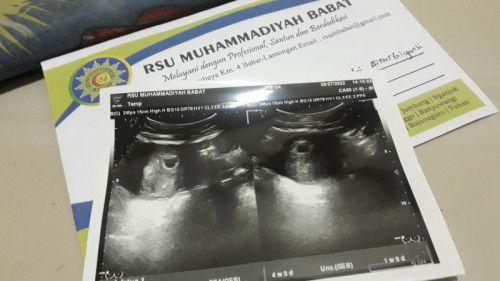 Bunda mau tanya saya hamil 4week 3day tadi di usg baru kelihatan kantung aja
