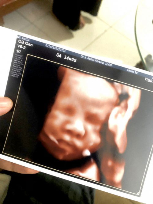 34weeks tp udh mules+kontraksi