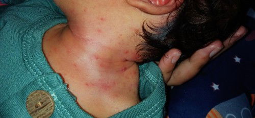 Bintik merah / ruam di leher