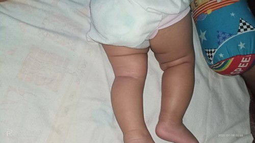 dysplasia bayi 5 bulan