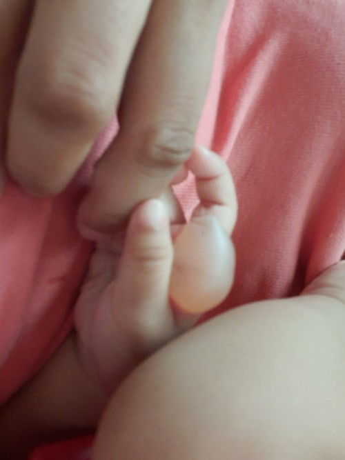 Paltos sa napasong kamay ni baby