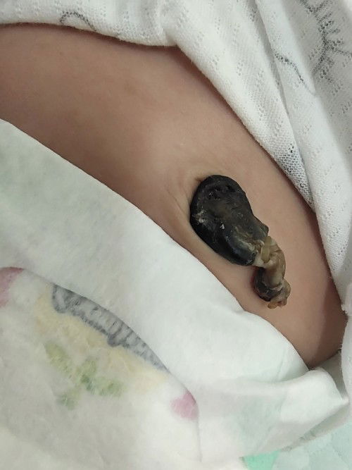 23วันสะดือลูกยังไม่หลุด