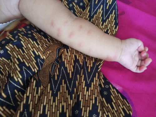 Bentol gigitan nyamuk