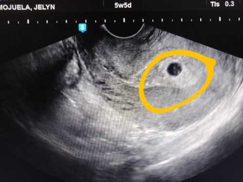 Normal po ba na 4weeks wala pa madetect na fetal pole sa ultrasound??? Nagwoworry kc aq π