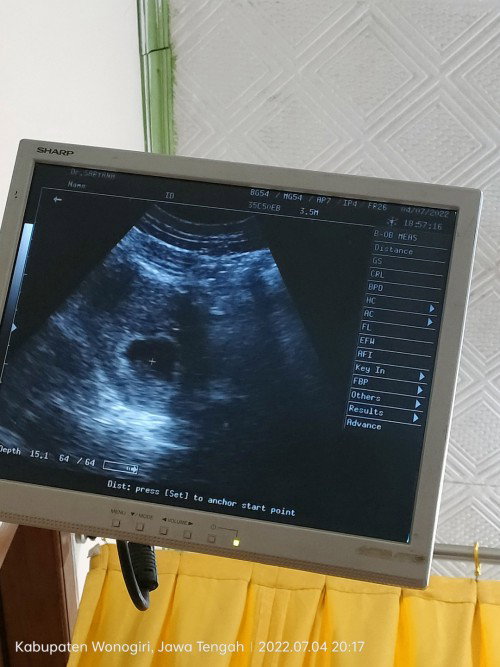 Bunda pernah denger rahim Retro kah? Usia kandungan 10W janin susah nampak