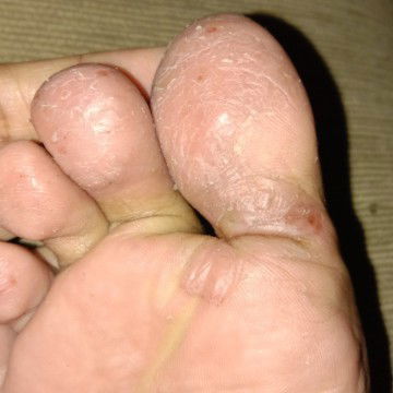 pompholyx penyakit kulit