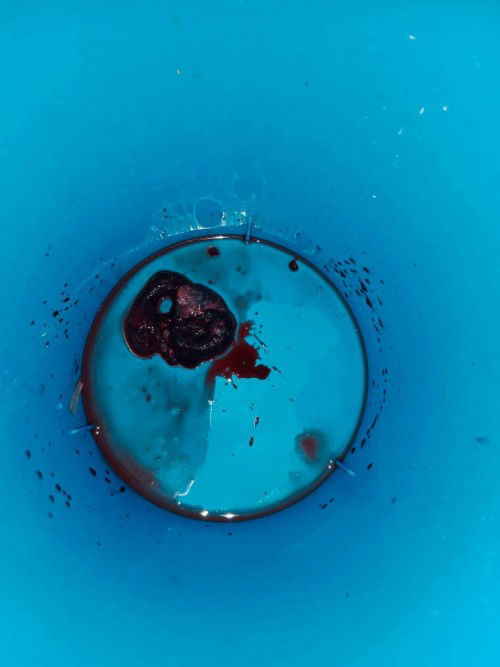 การแท้งบุตร