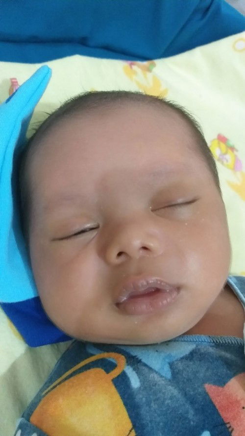 ASI, Sariawan newborn