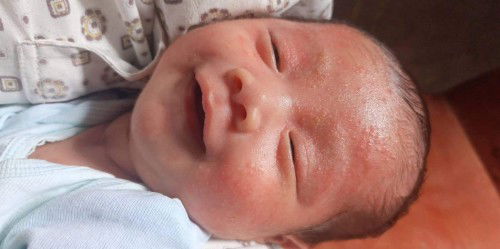 Baby acne