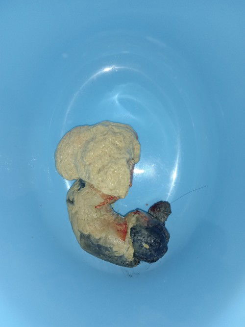 Anak saya  berumur 1 tahun 4bulan tapi sudah 2 kali dalam minggu ni dia berak macam ni.