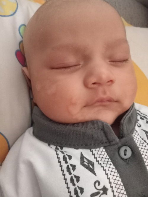 bayi 2bulan, ruam ASI