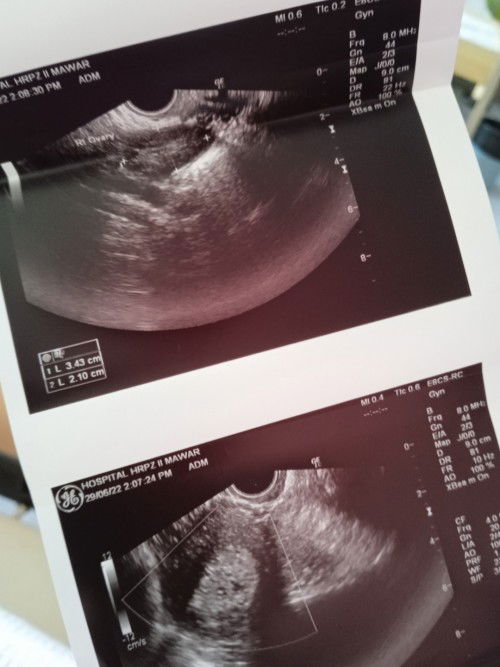 Mengandung tapi scan tak nampak