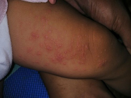 Ano po kaya tumubo sa baby ko na rashes dumadami na po kasi sya 😥