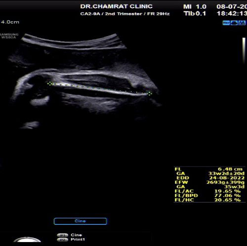 แม่ท่านไหน ท้อง 33 สัปดาห์  กับ น้ำหนักลูก 3,000 กรัมแล้วบ้างเอ่ย? แม่แอบกังวลตามคุณหมอบอก😅