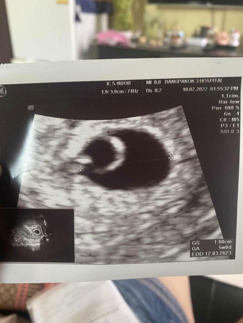 ตั้งครรภ์ 5 สัปดาห์ แม่ๆบ้านไหนขนาดไหนกันบ้างคะ😬