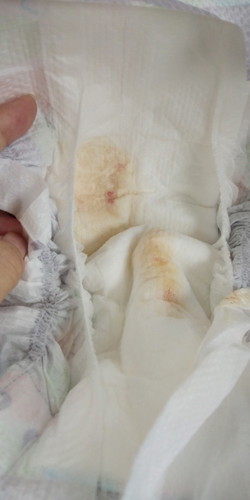 Worried, ftm dugo po ito sa diaper ni lo😥😥
