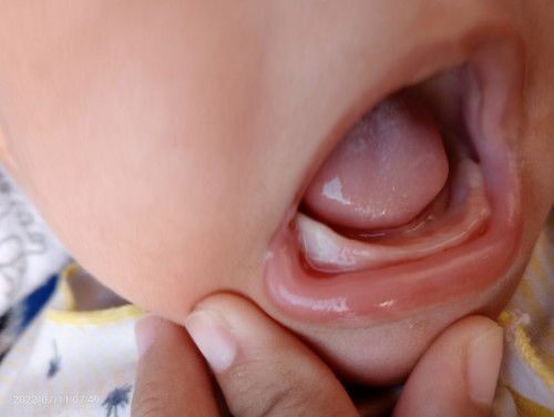 Sariawan atau memang gusi bayi seeperti itu
