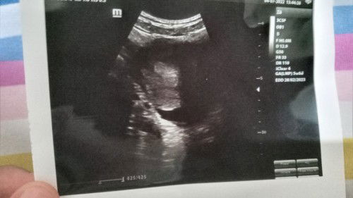 Hamil 6w tapi masih penebalan dinding rahim itu wajar nggak ya bund.