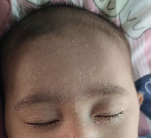 Bercak putih di wajah