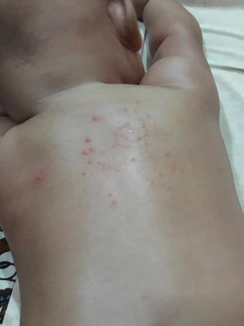 Bintik bintik merah dipunggung