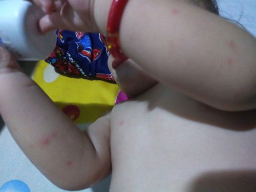 Worried na talaga ako sa mga pula pula sa katawan ng baby ko pa help nman po.