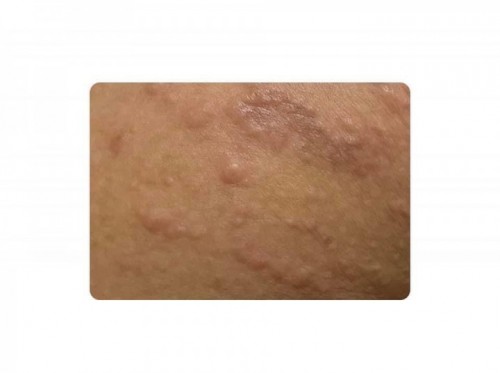 Rash, anyone experience this? Im in my 3rd tri