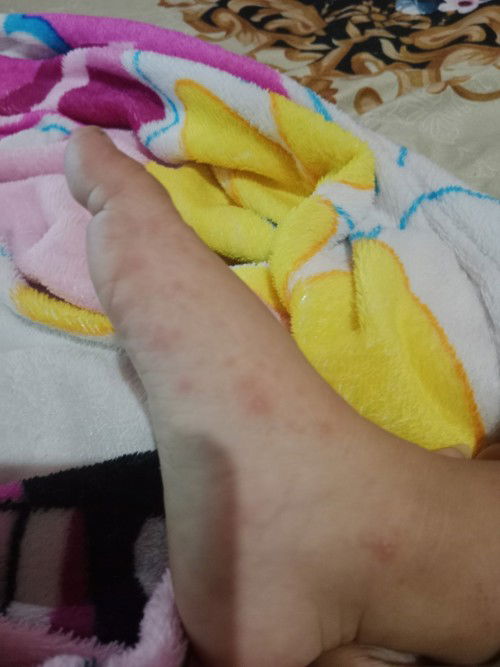 Hand-mouth-foot disease