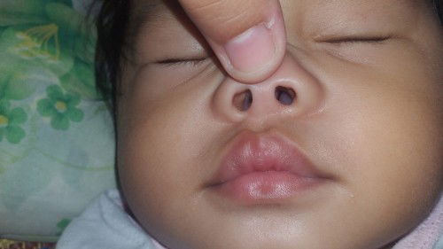 Mag ask lng po aq mga momsh if normal ba ung ganitong ilong ni baby prang my polyps sa loob wla