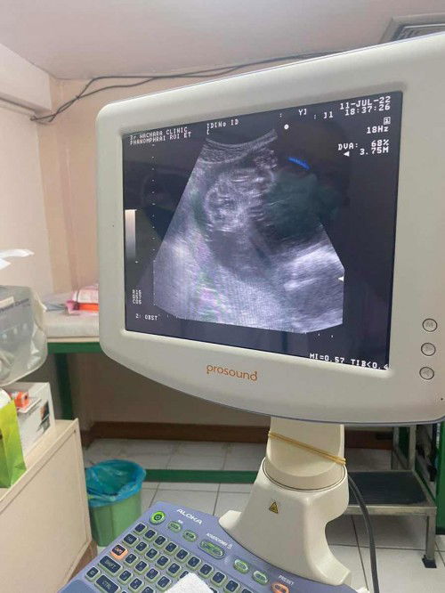 24+1w ซาวแล้วหมอสงสัยว่าน้องเป็นปากแหว่งเพดานโหว่ ใครเคยมีประสบการณ์แบบนี้บ้างคะ แม่แอบกังวล คิดมากใจหายเลย