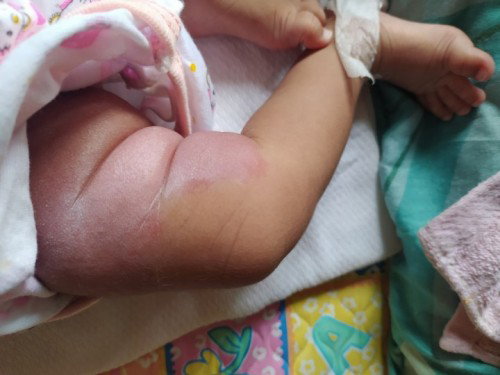 Namamagang rashes sa private area at legs