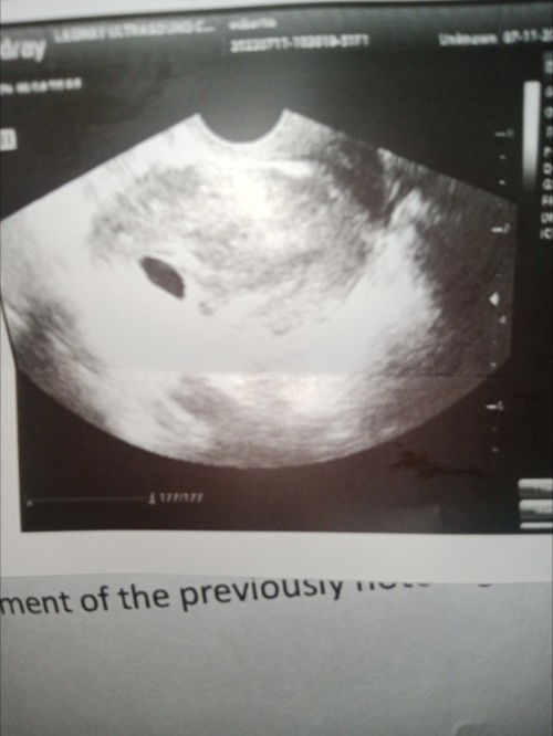Mga sis sino nakaranas dto ng blighted ovum daw sa 6 weeks and 5 days