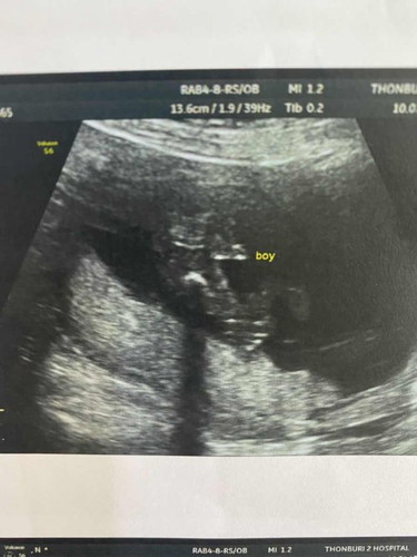 ตรวจคัดกรองดาวน์ซินโดม