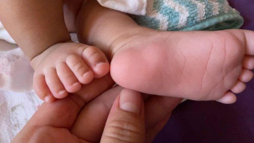 น้อง 1เดือน 17 วันขานัองก่อนถึงส้นเท้า มีนูนแบบนี้สองข้าง