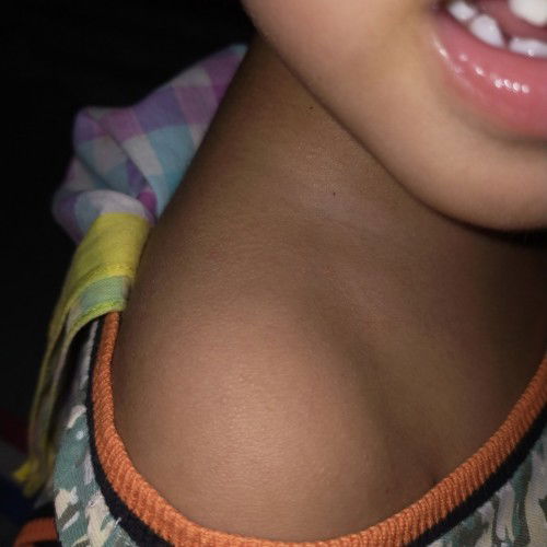 tanong lang po sa Pedia po ba ako papaconsult itong baby chicken skin na tinatawag worry po ako.